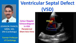 Ventricular Septal Defect VSD [upl. by Ladnar146]