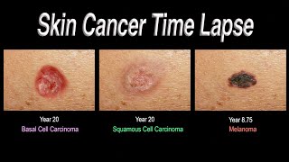 Skin Cancer Time Lapse Basal Cell Carcinoma Squamous Cell Carcinoma Melanoma [upl. by Ysnap]