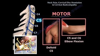 Neck Pain Cervical Disc Herniation amp RadiculopathyEverything You Need To Know  Dr Nabil Ebraheim [upl. by Htebazie]