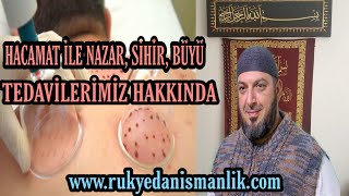 HACAMAT İLE NAZAR BÜYÜ SİHİR TEDAVİLERİMİZ HAKKINDA  RUKYE DANIŞMANLIK [upl. by Yvi]