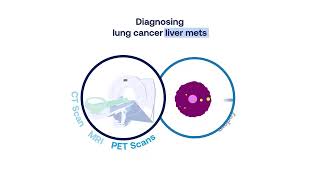 Lung Cancer Liver Metastasis Symptoms Diagnosis and Treatment 2 min [upl. by Krock]