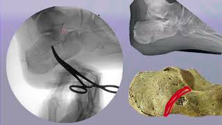 Basics of Calcaneum RadiographyFluoroscopy and Radiographic Anatomy of Calcaneum [upl. by Beverle581]