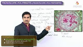 Microscopic polyangiitis MPA Pathology  Vasculitis USMLE Step 1 [upl. by Keller]