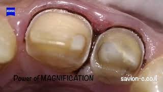 Less Invasive Veneer Preparation with Magnification Enhancing Your Smile [upl. by Baecher]