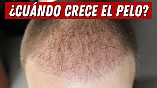 45 Meses de MI TRASPLANTE CAPILAR Y NO TENGO PELO [upl. by Amabel]