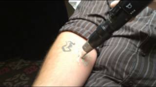 PicoSure Laser Tattoo Removal Demonstration in Toronto  SpaMedicaTV [upl. by Inavoj]