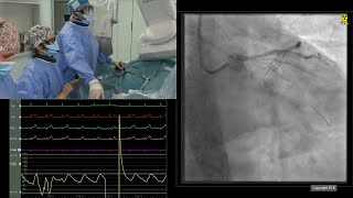 Optimising treatment for patients with severe calcified lesions the role of orbital atherectomy [upl. by Sholley305]