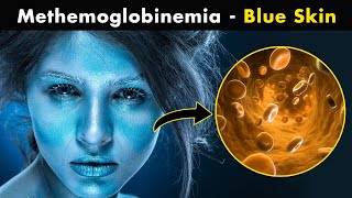 How Methemoglobinemia Effects our body UrduHindi [upl. by Ahsan]