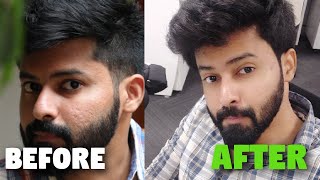 Minimise Large Pores  Acne Scars Control  முகத்தில் உள்ள பள்ளம் நீங்க இதைத்தான் செய்யனும் [upl. by Aidas205]