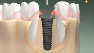 Zahnimplantation in 3D  Dental Implant 3D animation [upl. by Ahsiym]