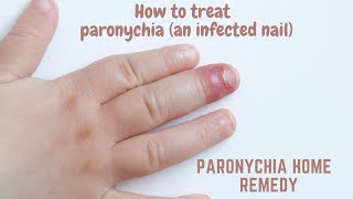 Paronychia home remedy  How to treat paronychia an infected nail [upl. by Nivar499]