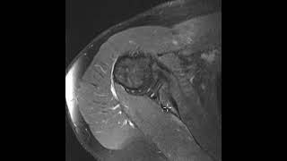 Glenoid hypoplasia and posterior labral tear [upl. by Cassius]