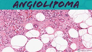 Angiolipoma 5Minute Pathology Pearls [upl. by Mazel]