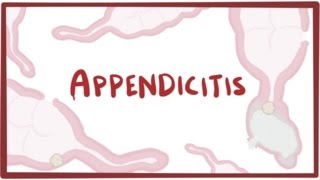 Appendicitis  causes symptoms diagnosis treatment amp pathology [upl. by Noletta]