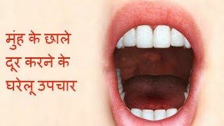 1 घंटे में मुंह और जीभ के छाले ठीक करने के लिए घरेलु उपाय  Home Remedy for Mouth amp Tongue Ulcers [upl. by Leihcim]