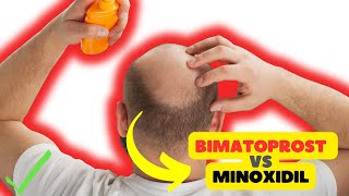 Bimatoprost vs Minoxidil Exploring Solutions for Hair Growth [upl. by Tiras]