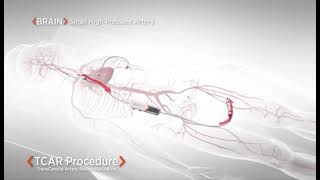 TCAR  Transcarotid Artery Revascularization [upl. by Acirederf]