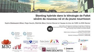 Stenting hybride dans la tétralogie de Fallot [upl. by Avin]