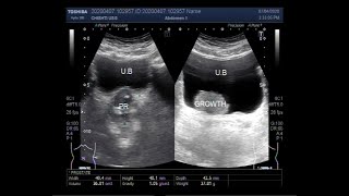 Ultrasound Video showing a Tumor in Urinary Bladder [upl. by Blasius]