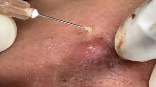 Big Cystic Acne Blackheads Extraction Blackheads amp Milia Whiteheads Removal Pimple Popping [upl. by Oniotna850]