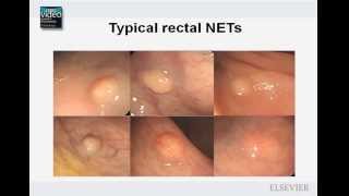 The Morphologic Assessment of Rectal Neuroendocrine Tumors [upl. by Einolem]