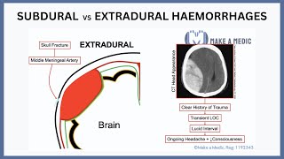 Subdural vs Extradural Haemorrhages Explained [upl. by Campney438]