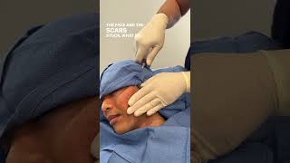 How I Diagnose and Treat my Patients with SEVERE Acne Scars 👨‍🏫 [upl. by Llenrev]