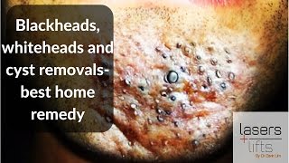 Blackheads whiteheads and cyst removal best home remedies [upl. by Nelac]