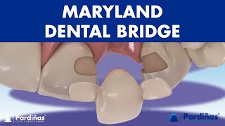 MARYLAND bridge  A DENTAL BRIDGE alternative for missing teeth © [upl. by Ealasaid613]