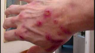 The Morgellons Lesion [upl. by Eelyk]