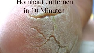 Hornhaut entfernen  Beste und schnellste Methode [upl. by Ytak]