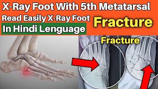 5th metatarsal fracture  Read Easily XRay Foot in hindi [upl. by Haneekas]