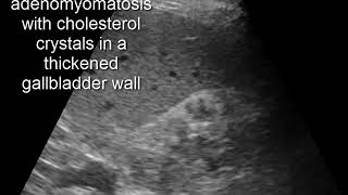 CASE 320 adenomyomatosis with cholesterol crystals in a thickened gallbladder wall [upl. by Nirred817]