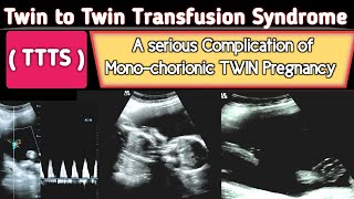 TTTS  Twin to Twin Transfusion Syndrome Ultrasound  A Serious COMPLICATION [upl. by Ziana895]