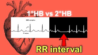 Understanding 1° amp 2° AV Block  Heart Block in 1 minute cardiology heartblock ecg [upl. by Maleeny]