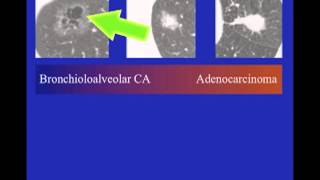 UCSF Radiology Lung Cancer Screening  Types of Cancer [upl. by Portuna376]