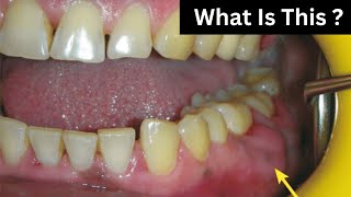 Dental Abscess  PERIODONTAL ABSCESS   Causes And Symptoms [upl. by Ylrahc64]