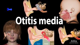 Otitis Media Anatomy Pathophysiology Risk Factors Types of OM Symptoms and Treatment Animation [upl. by Walton]