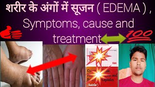 Edema शरीर के अंगों में सूजन  EDEMA  Symptoms cause and treatment  Abhia2zmedical [upl. by Druce223]