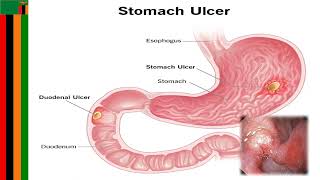 peptic Ulcerspathophysiology [upl. by Broeder115]