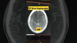 CT Brain Angiography Diagnosing AVM shorts trending viral radiology [upl. by Aerdnaid]