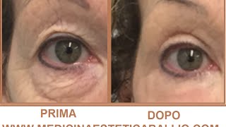 Blefaroplastica non chirurgica con Laser frazionato associato a PRP  Drssa Ballio [upl. by Amund]