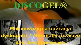 DISCOGEL® MAŁOINWAZYJNE PRZEZSKÓRNE LECZENIE DYSKPATII [upl. by Eiggep]