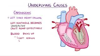 Pulmonary Edema causes symptoms diagnosis treatment pathology [upl. by Philana]