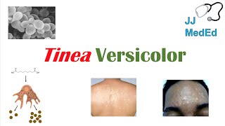 “Fungal Skin Infection of Many Colors” Tinea Versicolor  Pathogenesis Symptoms and Treatment [upl. by Salvidor]