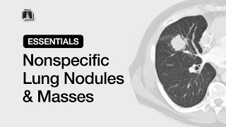 Nonspecific Lung Nodules amp Masses  Chest Radiology Essentials [upl. by Killam]