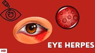 Eye Herpes Causes Signs and Symptoms Diagnosis and Treatment [upl. by Aisan]