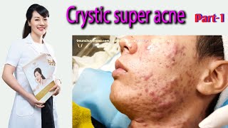 Acne treatment reputation effective at Hien Van Spa391I Bách Tùng [upl. by Alleuqahs]