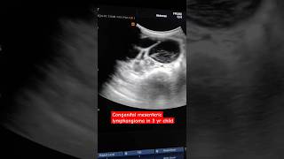 Congenital mesenteric lymphangioma in a 3 yr boy which was herniating into the right scrotal sac [upl. by Nadean]