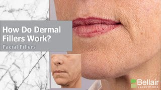 How do dermal fillers work [upl. by Mari384]